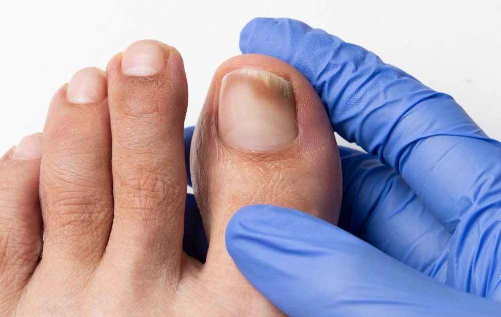Nail Fungus