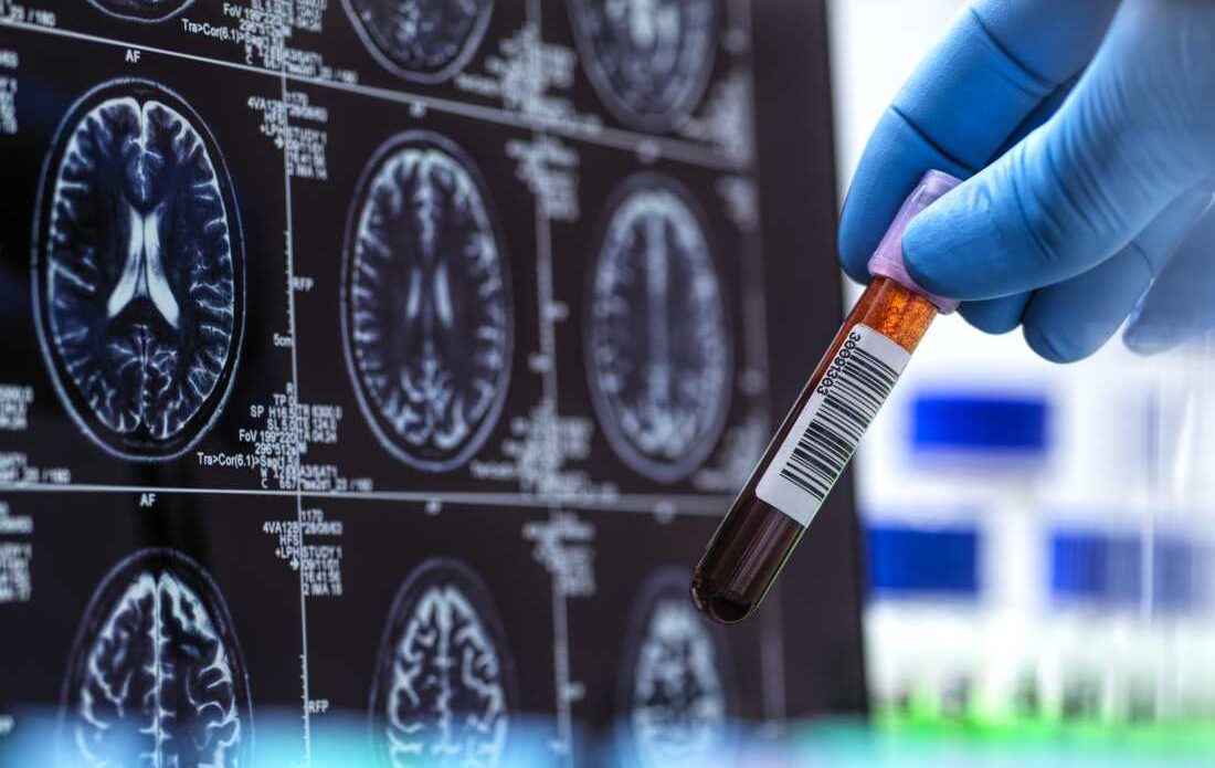 Hand of scientist examining blood sample near MRI scan on screen