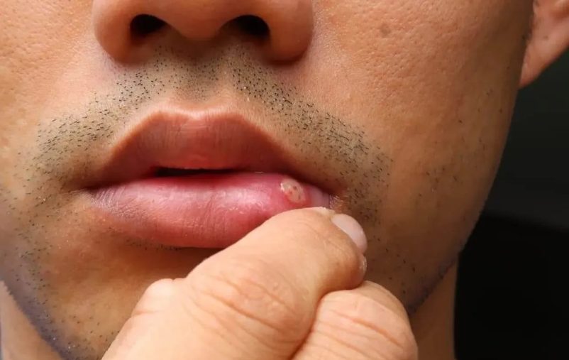 How to Treat Cracked Corners of the Mouth
